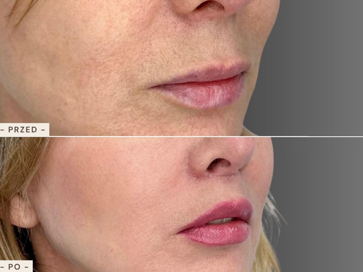 Lip lift - efekt przed i po