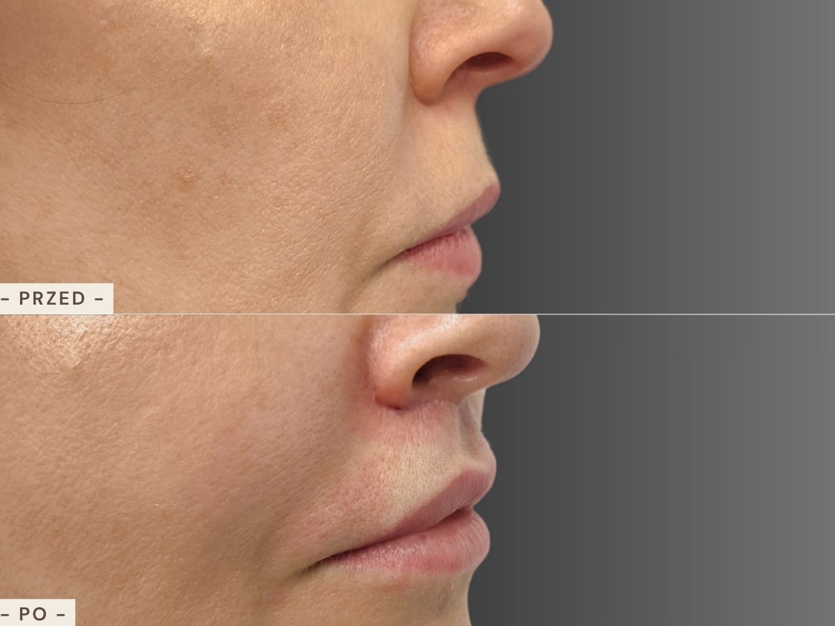 Lip lift - efekt przed i po