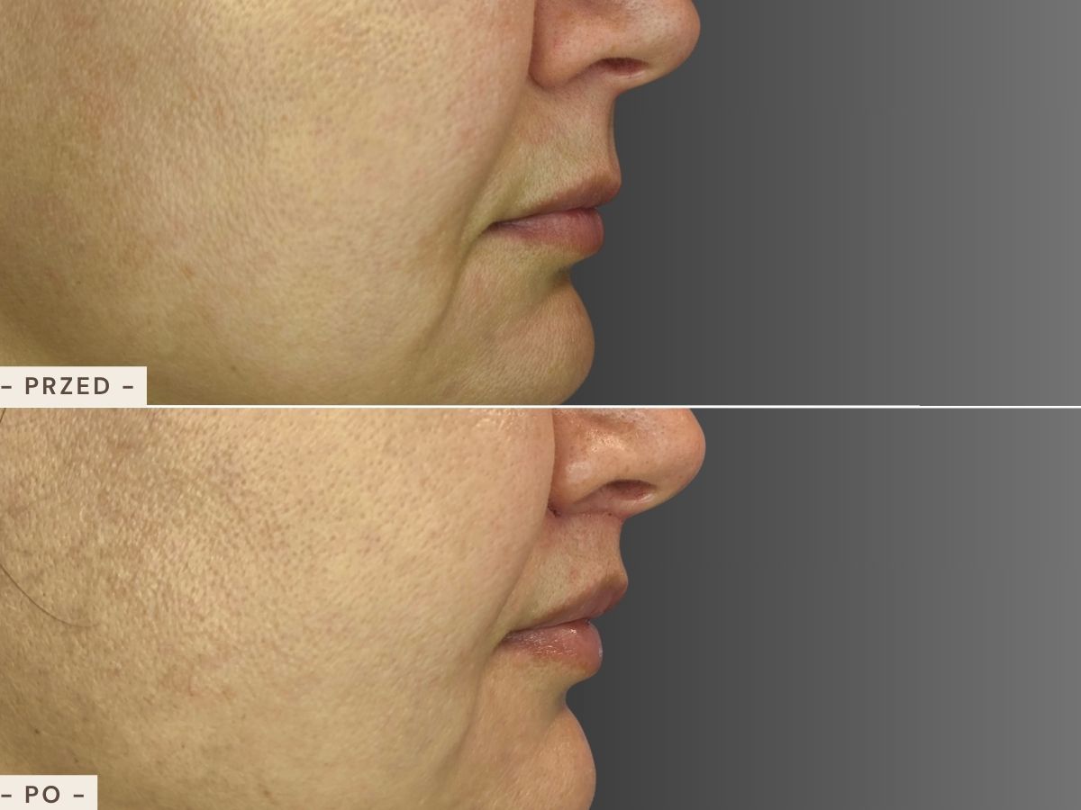 Lip lift - efekt przed i po